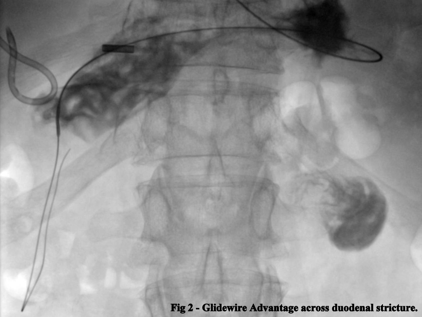Fig 2. Glidewire Advantage across duodenal stricture
